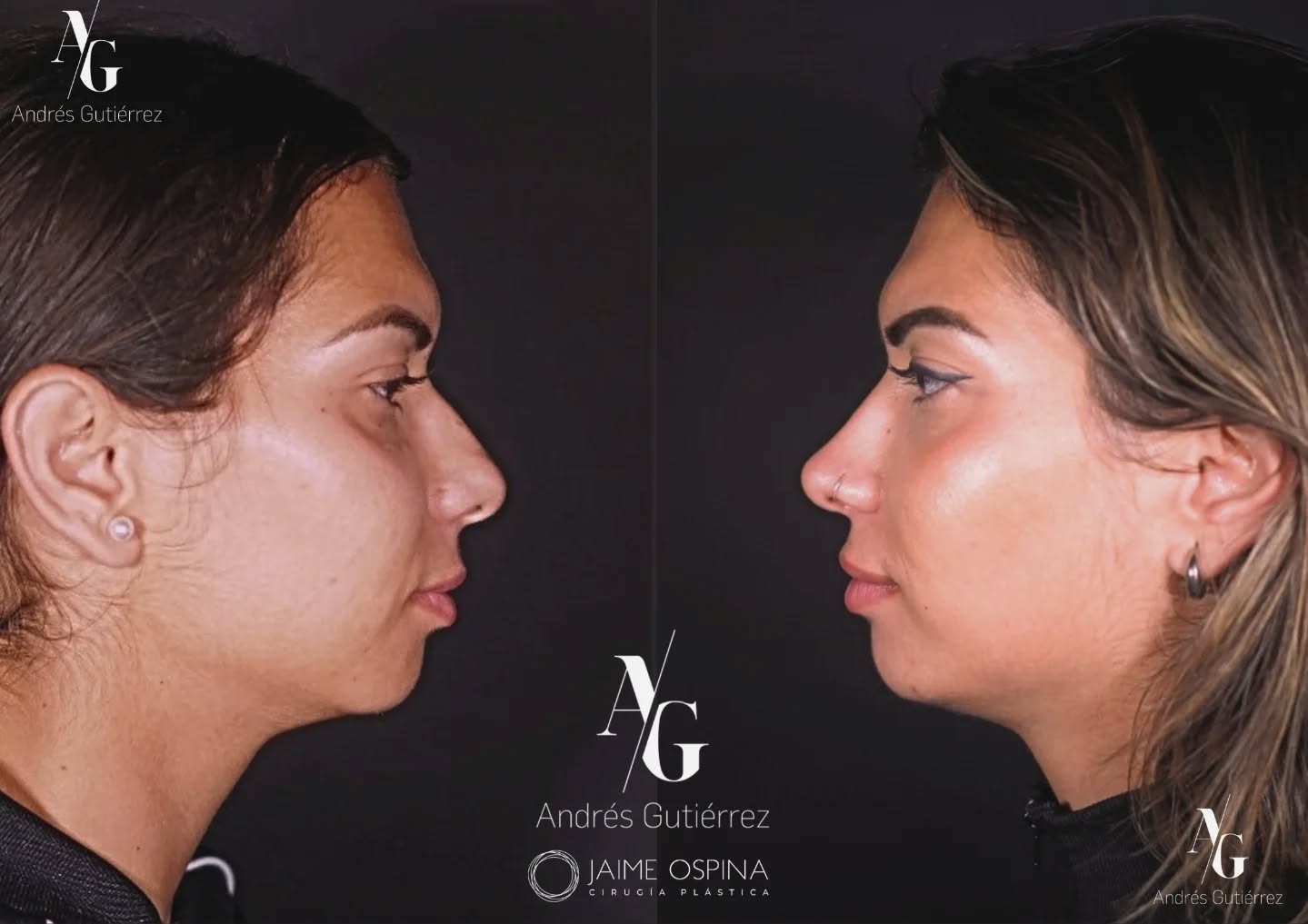 Rinoplastia Ultrasónica Estructural + Radiofrecuencia de cornetes inferiores + Septoplastia, resultado a los 8 meses.
°
°
Equipo quirúrgico: #rhinoteam 🤜🏽🤛🏼
@drjaimeospina CPL
@andresgutierrez.dr ORL
°
°
#rinoplastia #rinoplastiaultrasonica #ultrasonicrhinoplasty
#rhinoplasty #cirugiadenariz #nosejob #cirugiaplasticafacial #facialplasticsurgery #resultadosnaturales #antesydespues #beforeandafter #nosesurgery #rhinoplastybeforeandafter #rhinoplastyspecialist #facialplasticsurgery #topdoc #aesthetic #rinoplasti #estetik #estetikburun #burunestitigi #nose #nasen #newnose #cirugiaplastica #chirurgiaplastica #chirurgieplastique #rhinoplastie #rinoplastica