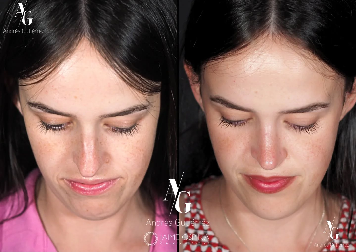 📸 Resultado a los 7 meses ✨
Hoy comparto la evolución de este caso tras una Rinoplastia Ultrasónica Estructural + Radiofrecuencia de Cornetes Inferiores + Septoplastia, combinada con tratamiento de Ortodoncia para lograr una armonía facial más completa y una mejor función respiratoria.
🔹 Antes: desviación septal, alteración valvular interna, laterorrinia y una nariz a tensión que afectaban tanto la estética como la respiración.
🔹 Después de 7 meses: mejoría estructural, válvulas más estables y un perfil más equilibrado. La ortodoncia potenció el resultado final, optimizando la relación entre labios, sonrisa y nariz.
°
°
Equipo quirúrgico:
@drjaimeospina
@andresgutierrez.dr
°
°
#rinoplastia #rinoplastiaultrasonica #ultrasonicrhinoplasty
#rhinoplasty #cirugiadenariz #nosejob #cirugiaplasticafacial #facialplasticsurgery #resultadosnaturales #antesydespues #beforeandafter #nosesurgery #rhinoplastybeforeandafter #rhinoplastyspecialist #topdoc #aesthetic #rinoplasti #estetik #estetikburun #burunestitigi #nose #nasen #newnose #cirugiaplastica #chirurgiaplastica #chirurgieplastique #rhinoplastie #rinoplastica