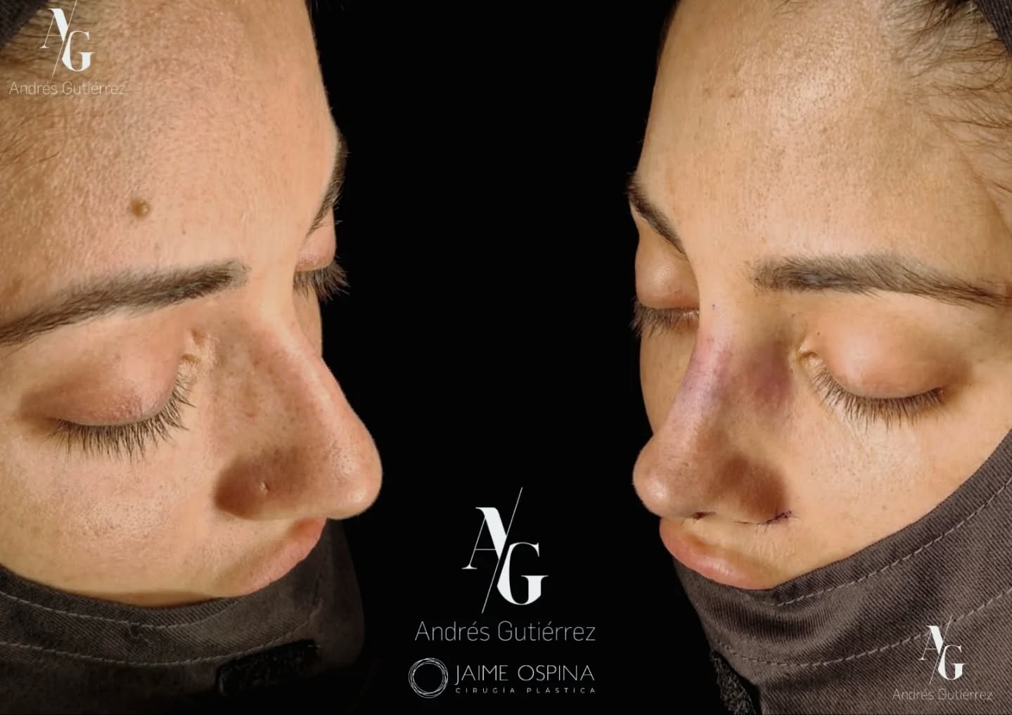 Rinoplastia ultrasónica estructural + septoturbinoplastia.
Resultado postoperatorio inmediato.
Se realizó reducción estructural, refinamiento y desproyección de punta, junto con optimización funcional respiratoria.
La cirugía nasal ideal no enfrenta estética y función. Las integra en un resultado armónico y estable.
Dos especialidades. Un mismo objetivo: forma y función en equilibrio.
👃🏻 Otorrinolaringología @andresgutierrez.dr (ORL)
✨ Cirugía Plástica @drjaimeospina (CPL)
#RinoplastiaUltrasonica #RinoplastiaEstructural #Septoturbinoplastia #CirugiaFacial #RinoplastiaFuncional TrabajoEnEquipo ResultadosNaturales