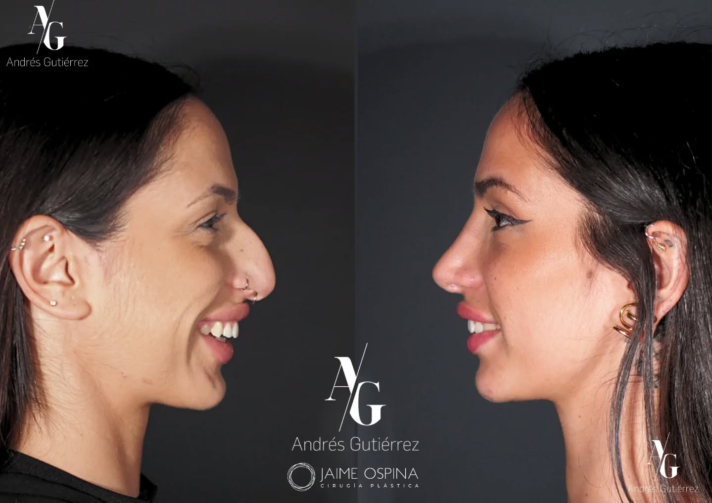 La nariz es el centro del rostro… y cambiarla lo cambia todo. 🤍 Es por eso que la rinoplastia mi cirugía favorita: pequeños cambios, grandes transformaciones. 👃 ✨
Equipo quirúrgico multidisciplinar 🤝🏼
@drjaimeospina
@andresgutierrez.dr
#RinoplastiaUltrasonica #RinoplastiaEstructural #Septoturbinoplastia #CirugiaFacial #RinoplastiaFuncional TrabajoEnEquipo ResultadosNaturales