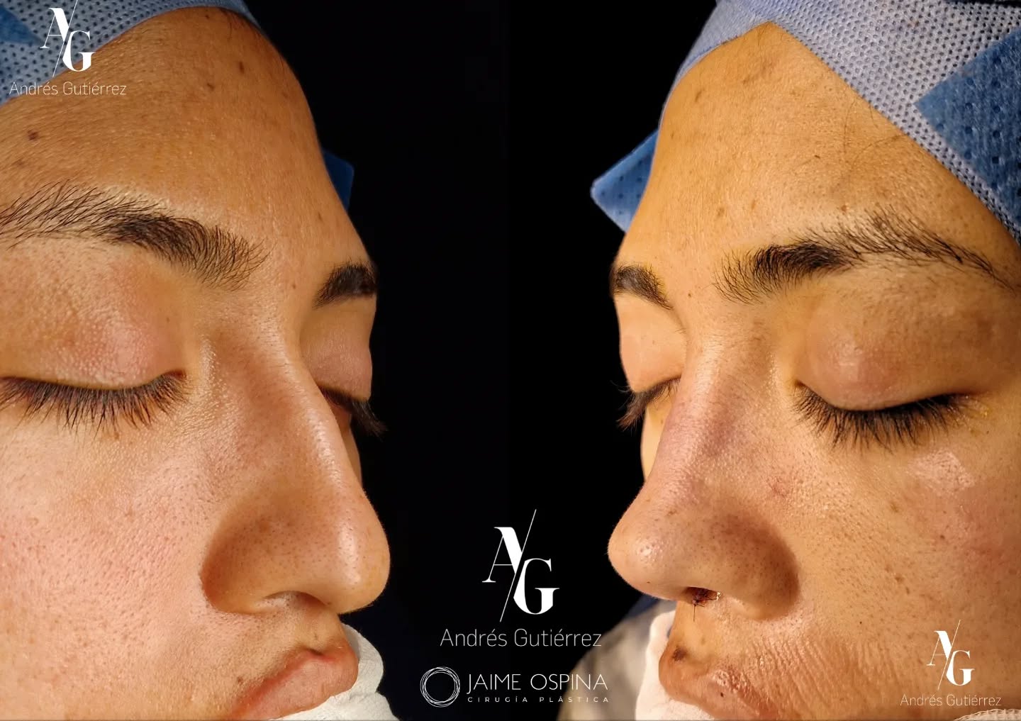 Rinoplastia Ultrasónica Estructural + septoturbinoplastia ♀️, resultado inmediato postQx.
°
°
Nariz étnica. Pequeña giba dorsal, punta ptósica y poco definida, a pesar del grosor de la piel logramos una buena definición.
°
°
Equipo quirúrgico:
@drjaimeospina CPL
@andresgutierrez.dr ORL
°
°
#rinoplastia #rinoplastiaultrasonica #ultrasonicrhinoplasty
#rhinoplasty #cirugiadenariz #nosejob #cirugiaplasticafacial #facialplasticsurgery #resultadosnaturales #antesydespues #beforeandafter #nosesurgery #rhinoplastybeforeandafter #rhinoplastyspecialist #facialplasticsurgery #topdoc #aesthetic #rinoplasti #estetik #estetikburun #burunestitigi #nose #nasen #newnose #cirugiaplastica #chirurgiaplastica #chirurgieplastique #rhinoplastie #rinoplastica