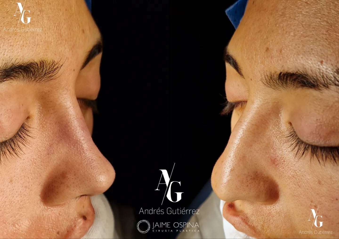 Rinoplastia Ultrasónica Estructural + septoturbinoplastia ♀️, resultado inmediato postQx.
°
°
Nariz étnica. Pequeña giba dorsal, punta ptósica y poco definida, a pesar del grosor de la piel logramos una buena definición.
°
°
Equipo quirúrgico:
@drjaimeospina CPL
@andresgutierrez.dr ORL
°
°
#rinoplastia #rinoplastiaultrasonica #ultrasonicrhinoplasty
#rhinoplasty #cirugiadenariz #nosejob #cirugiaplasticafacial #facialplasticsurgery #resultadosnaturales #antesydespues #beforeandafter #nosesurgery #rhinoplastybeforeandafter #rhinoplastyspecialist #facialplasticsurgery #topdoc #aesthetic #rinoplasti #estetik #estetikburun #burunestitigi #nose #nasen #newnose #cirugiaplastica #chirurgiaplastica #chirurgieplastique #rhinoplastie #rinoplastica