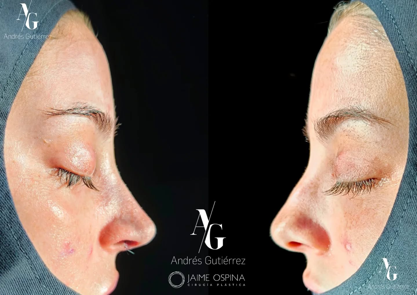 Resultado postquirúrgico inmediato.👃✨
Caso postraumático de alta complejidad. Septo y cartílagos laterales (superiores e inferiores) que presentaban una gran deformidad estructural.
Logramos restaurar el soporte anatómico y la simetría, funcional y estética, en un solo tiempo quirúrgico.
Equipo quirúrgico: #rhinoteam 🤜🏽🤛🏼 @drjaimeospina + @andresgutierrez.dr
#rinoplastia #rinoplastiaultrasonica #cirugiafacial #antesydespues resultadosnaturales nosejob septoplastia