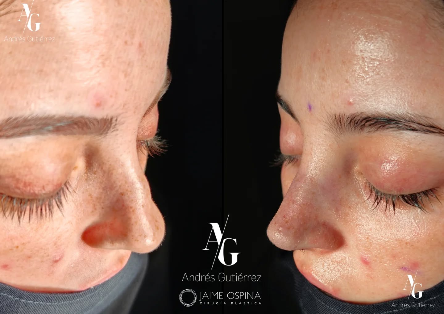 Resultado postquirúrgico inmediato.👃✨
Caso postraumático de alta complejidad. Septo y cartílagos laterales (superiores e inferiores) que presentaban una gran deformidad estructural.
Logramos restaurar el soporte anatómico y la simetría, funcional y estética, en un solo tiempo quirúrgico.
Equipo quirúrgico: #rhinoteam 🤜🏽🤛🏼 @drjaimeospina + @andresgutierrez.dr
#rinoplastia #rinoplastiaultrasonica #cirugiafacial #antesydespues resultadosnaturales nosejob septoplastia