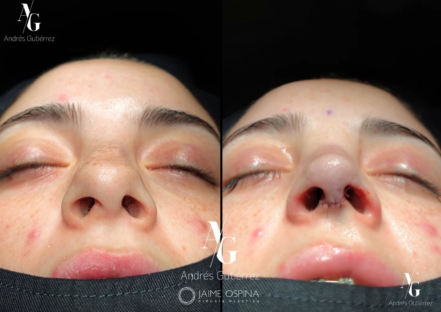 Resultado postquirúrgico inmediato.👃✨
Caso postraumático de alta complejidad. Septo y cartílagos laterales (superiores e inferiores) que presentaban una gran deformidad estructural.
Logramos restaurar el soporte anatómico y la simetría, funcional y estética, en un solo tiempo quirúrgico.
Equipo quirúrgico: #rhinoteam 🤜🏽🤛🏼 @drjaimeospina + @andresgutierrez.dr
#rinoplastia #rinoplastiaultrasonica #cirugiafacial #antesydespues resultadosnaturales nosejob septoplastia